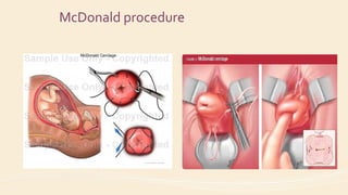 McDonald procedure
 