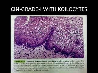 CIN-GRADE-I WITH KOILOCYTES
 