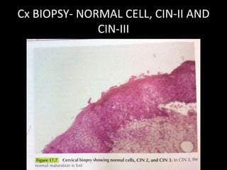 Cx BIOPSY- NORMAL CELL, CIN-II AND
              CIN-III
 
