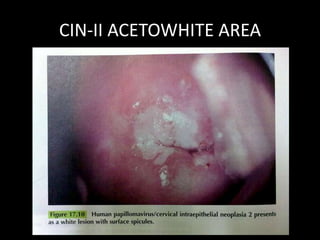 CIN-II ACETOWHITE AREA
 
