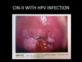 CIN-II WITH HPV INFECTION
 