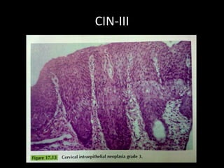 CIN-III
 