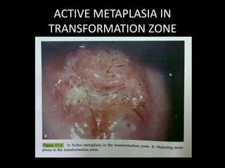 ACTIVE METAPLASIA IN
TRANSFORMATION ZONE
 