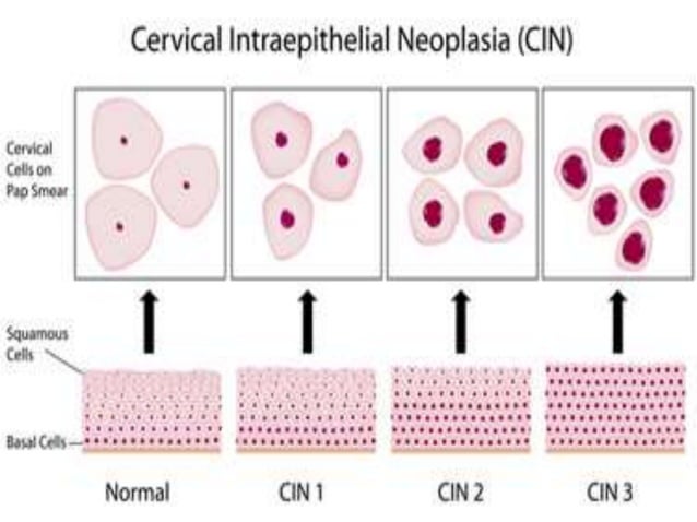 Cervical intraepithelial neoplasia