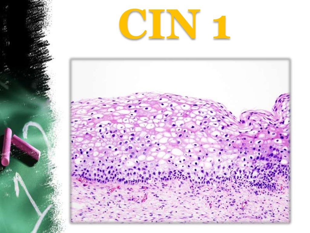 Cervical intraepithelial neoplasia