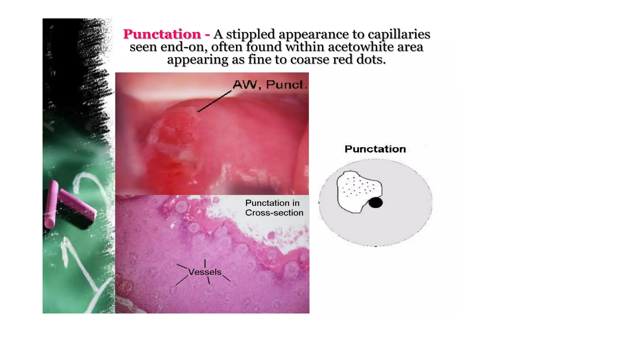 Cervical intraepithelial neoplasia.dpptx