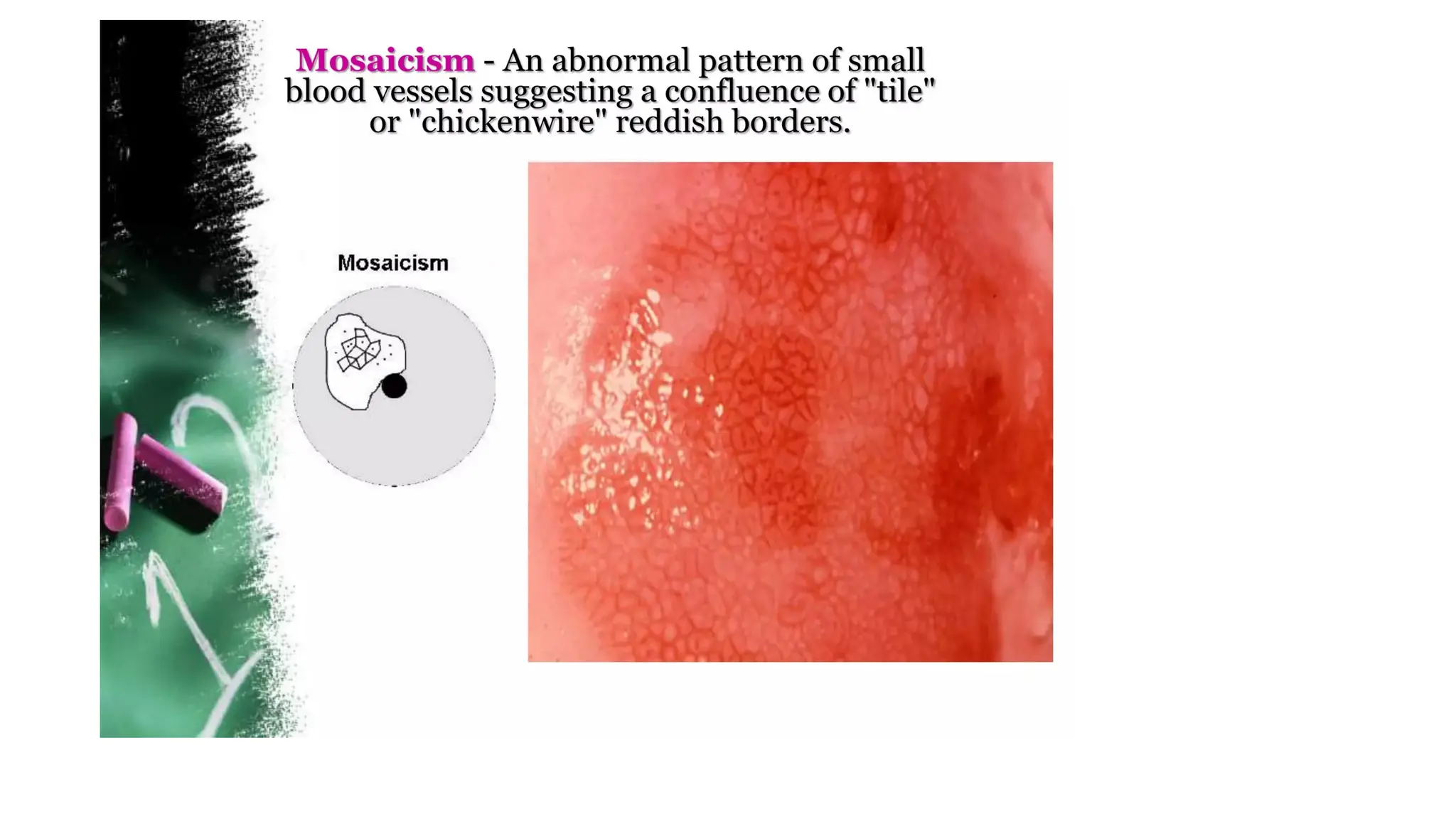 Cervical intraepithelial neoplasia.dpptx