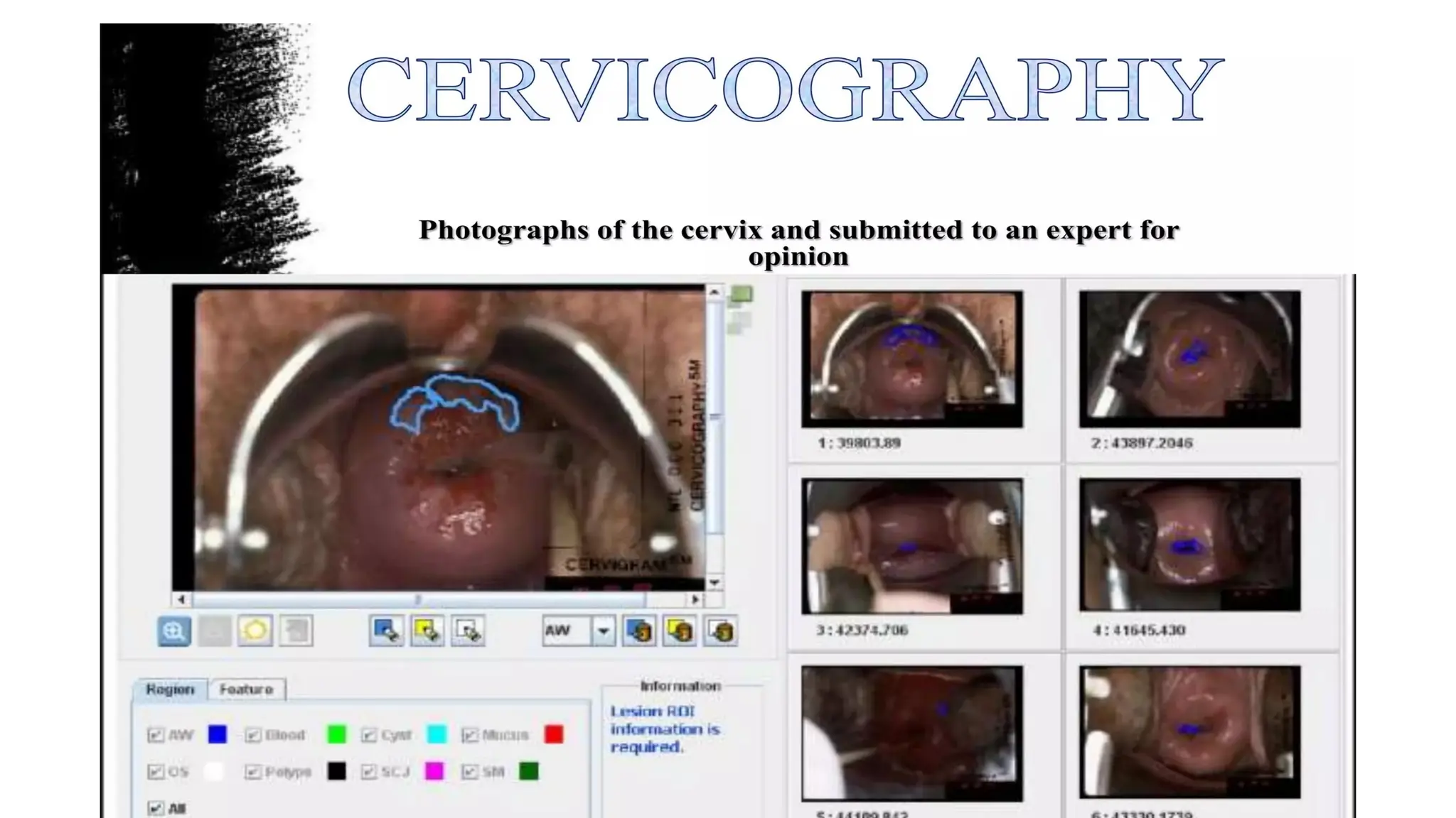 Cervical intraepithelial neoplasia.dpptx