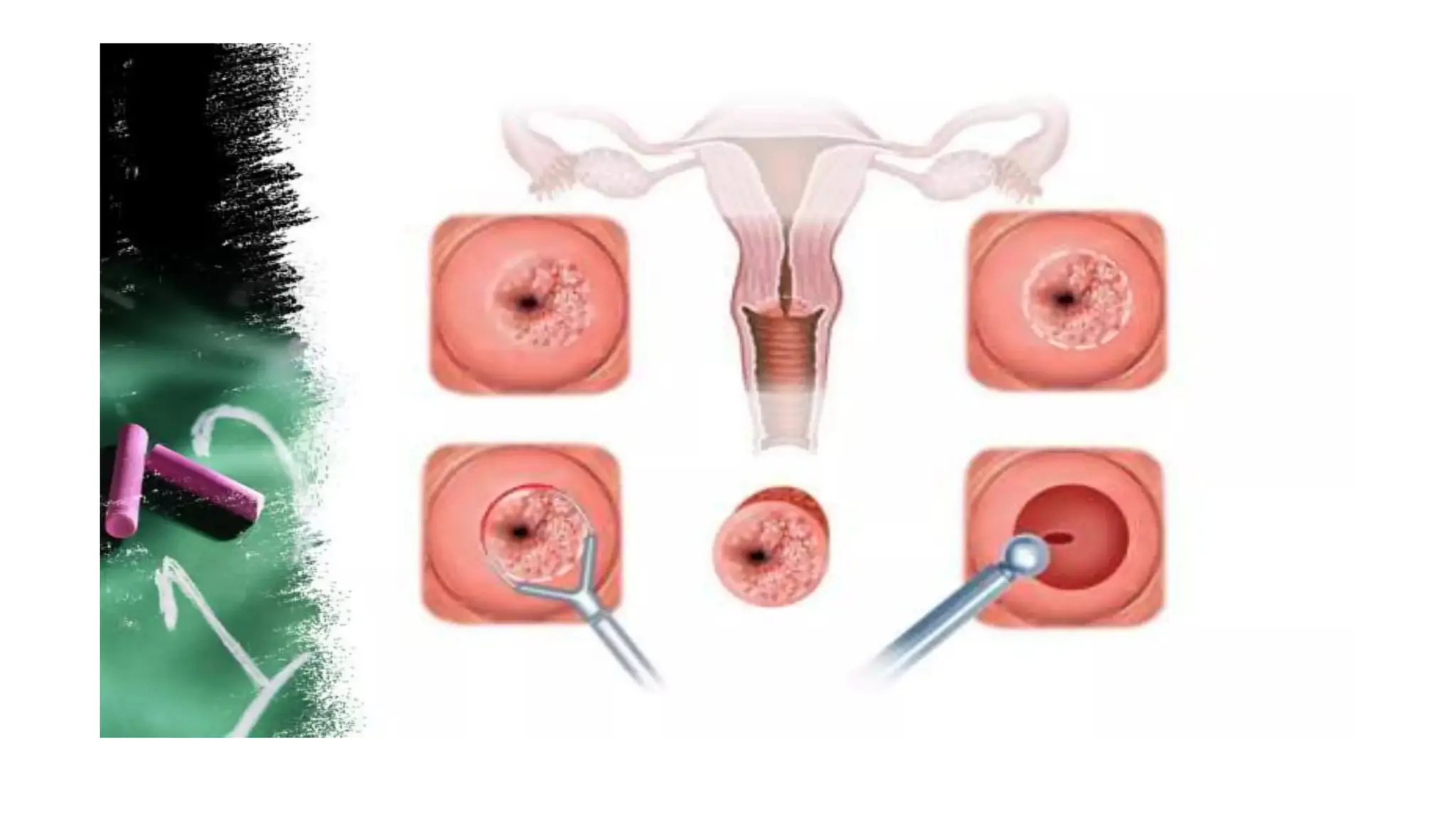 Cervical intraepithelial neoplasia.dpptx