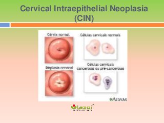 Cervical Intraepithelial Neoplasia
(CIN)
 