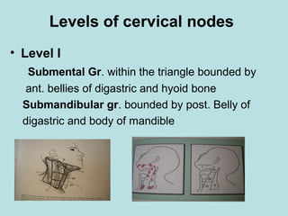 Levels of cervical nodes
• Level I
Submental Gr. within the triangle bounded by
ant. bellies of digastric and hyoid bone
Submandibular gr. bounded by post. Belly of
digastric and body of mandible
 