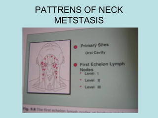 PATTRENS OF NECK
METSTASIS
 
