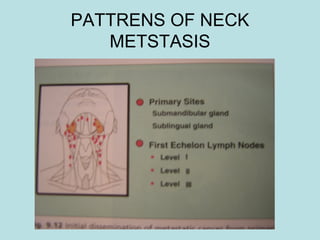 PATTRENS OF NECK
METSTASIS
 