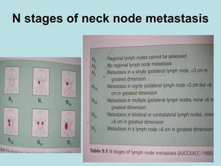 N stages of neck node metastasis
 