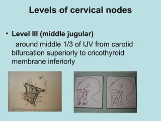 Levels of cervical nodes
• Level III (middle jugular)
around middle 1/3 of IJV from carotid
bifurcation superiorly to cricothyroid
membrane inferiorly
 