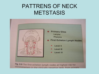 PATTRENS OF NECK
METSTASIS
 