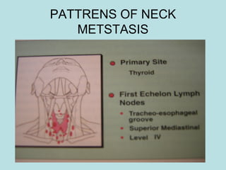 PATTRENS OF NECK
METSTASIS
 