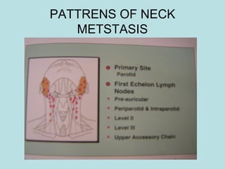 PATTRENS OF NECK
METSTASIS
 