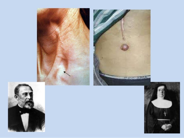 shotty cervical lymphadenopathy shotty cervical lymphadenopathy