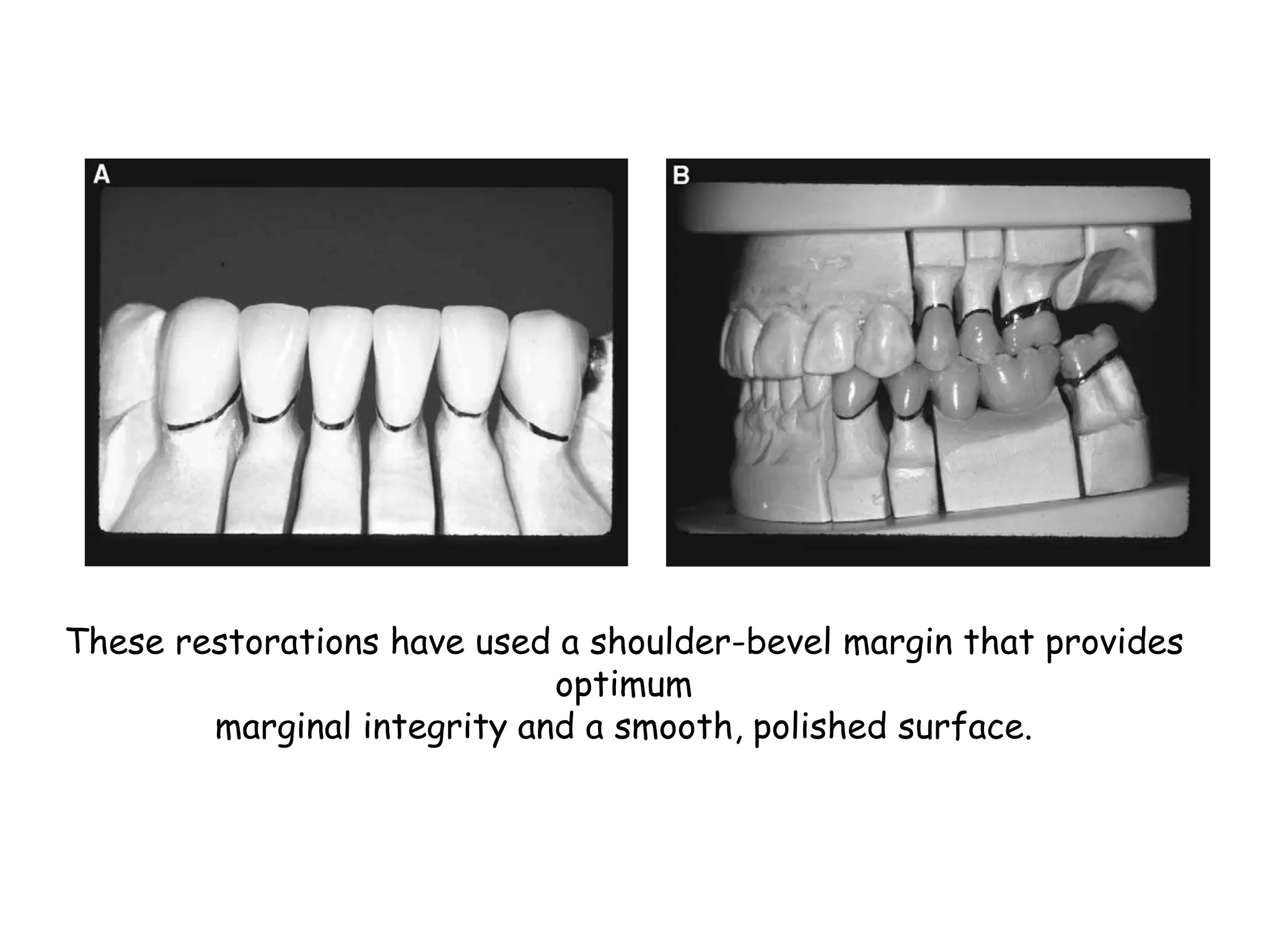 Cervical margin design | PPTX