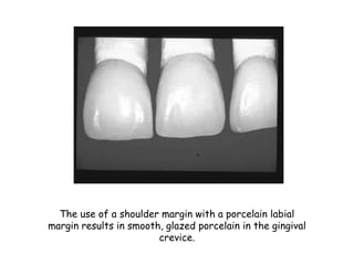 The use of a shoulder margin with a porcelain labial
margin results in smooth, glazed porcelain in the gingival
crevice.
 