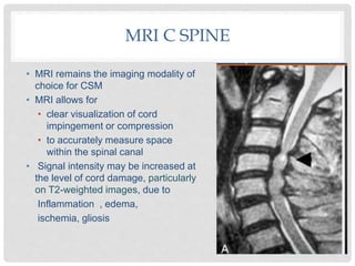 MRI C SPINE
• MRI remains the imaging modality of
choice for CSM
• MRI allows for
• clear visualization of cord
impingement or compression
• to accurately measure space
within the spinal canal
• Signal intensity may be increased at
the level of cord damage, particularly
on T2-weighted images, due to
Inflammation , edema,
ischemia, gliosis
 