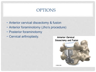 OPTIONS
• Anterior cervical discectomy & fusion
• Anterior foraminotomy (Jho’s procedure)
• Posterior foraminotomy
• Cervical arthroplasty.
 