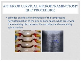 • provides an effective elimination of the compressing
herniated portion of the disc or bone spurs, while preserving
the remaining disc between the vertebrae and maintaining
spinal motion
ANTERIOR CERVICAL MICROFORAMINOTOMY
(JHO PROCEDURE)
 