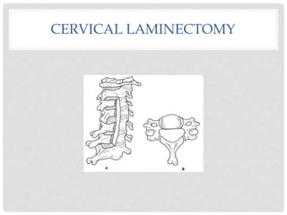 CERVICAL LAMINECTOMY
 