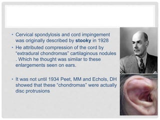 • Cervical spondylosis and cord impingement
was originally described by stooky in 1928
• He attributed compression of the cord by
“extradural chondromas” cartilaginous nodules
. Which he thought was similar to these
enlargements seen on ears.
• It was not until 1934 Peet, MM and Echols, DH
showed that these “chondromas” were actually
disc protrusions
 