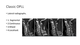 Cervical opll | PPTX