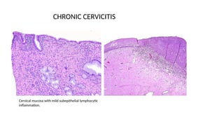 Cervical pathology (1).pdf bt dr almworek amar | PDF