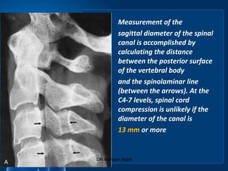 Measurement of the
sagittal diameter of the spinal
canal is accomplished by
calculating the distance
between the posterior surface
of the vertebral body
and the spinolaminar line
(between the arrows). At the
C4-7 levels, spinal cord
compression is unlikely if the
diameter of the canal is
13 mm or more
DR Mohsen Abad
 