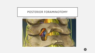 POSTERIOR FORAMINOTOMY
24
 