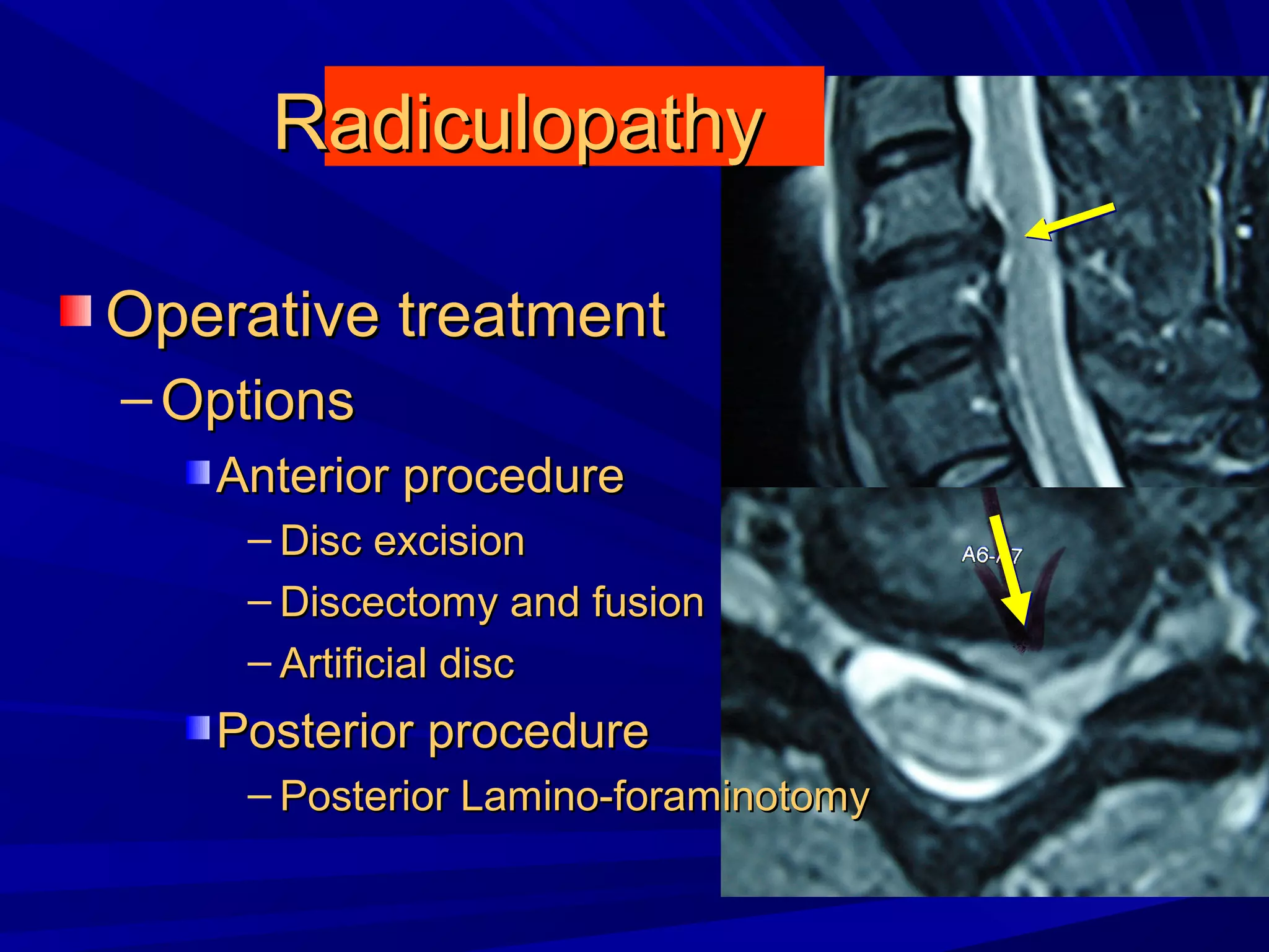 Cervical radiculopathy 1st mech diag 2008 | PPT