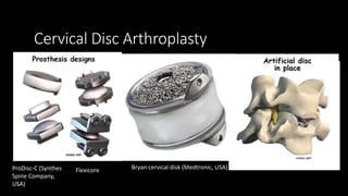 Cervical radiculopathy | PPSX