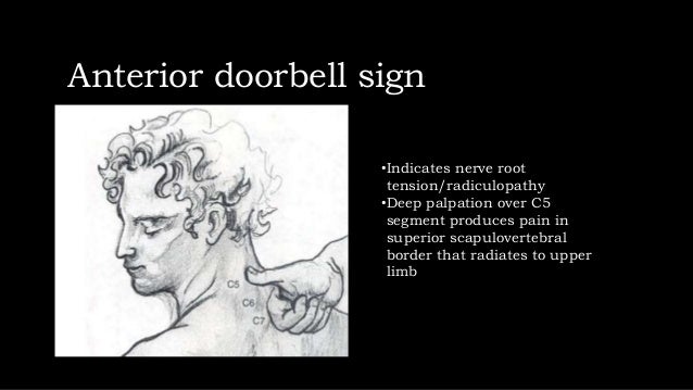 Cervical radiculopathy