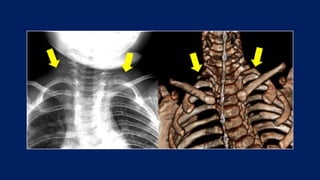 Cervical Ribs Presentation 3100.....pptx