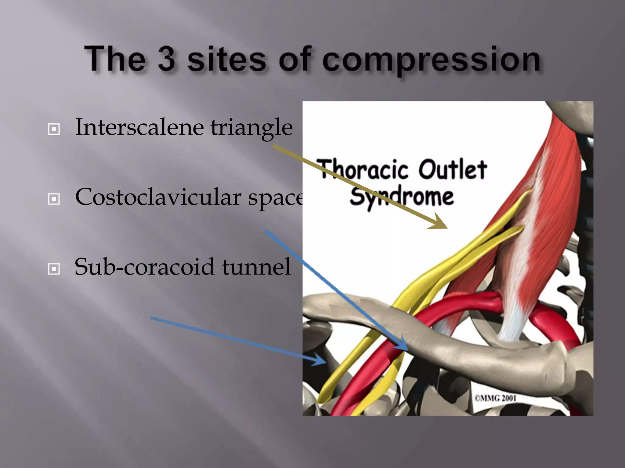 Cervical rib syndrome | PPTX
