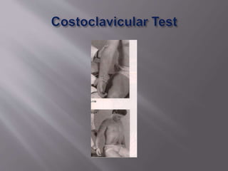 Test For Cervical Rib Cervical rib syndrome | PPTX