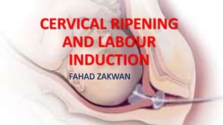 CERVICAL RIPENING
AND LABOUR
INDUCTION
FAHAD ZAKWAN
 