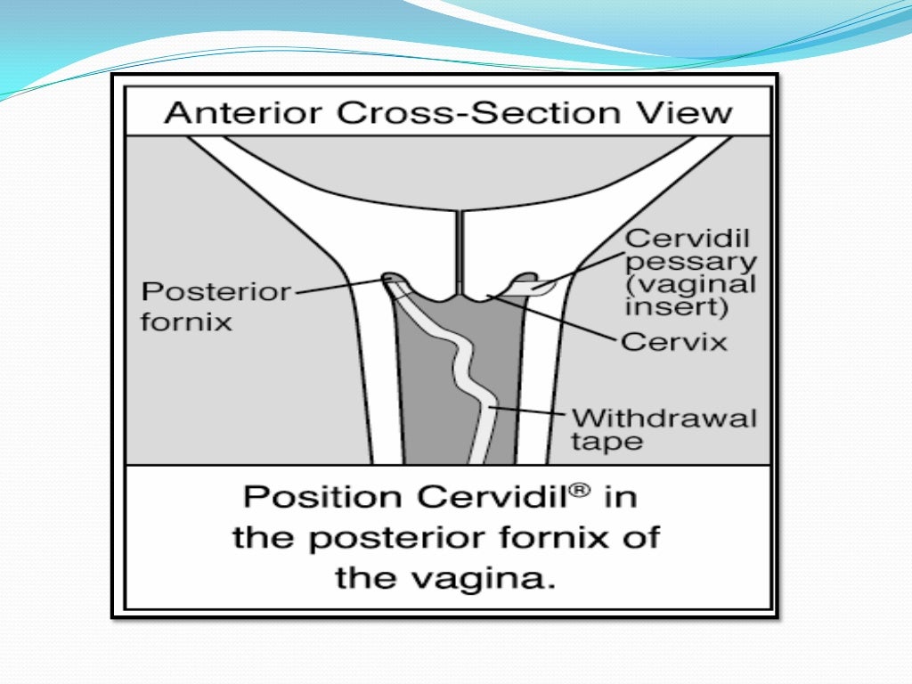 Cervical ripening and labour induction