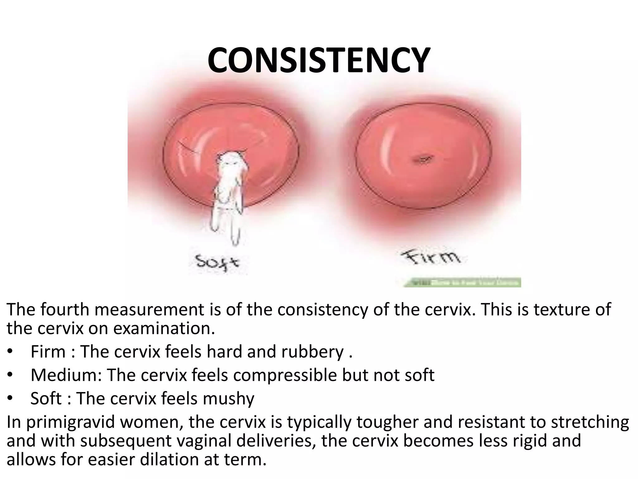 Cervical Ripe Cervical ripening and the bishop score | PPTX
