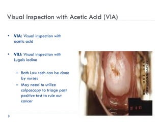 Visual Inspection with Acetic Acid (VIA)
• VIA: Visual inspection with
acetic acid
• VILI: Visual inspection with
Lugols iodine
– Both Low tech can be done
by nurses
– May need to utilize
colposcopy to triage post
positive test to rule out
cancer
 