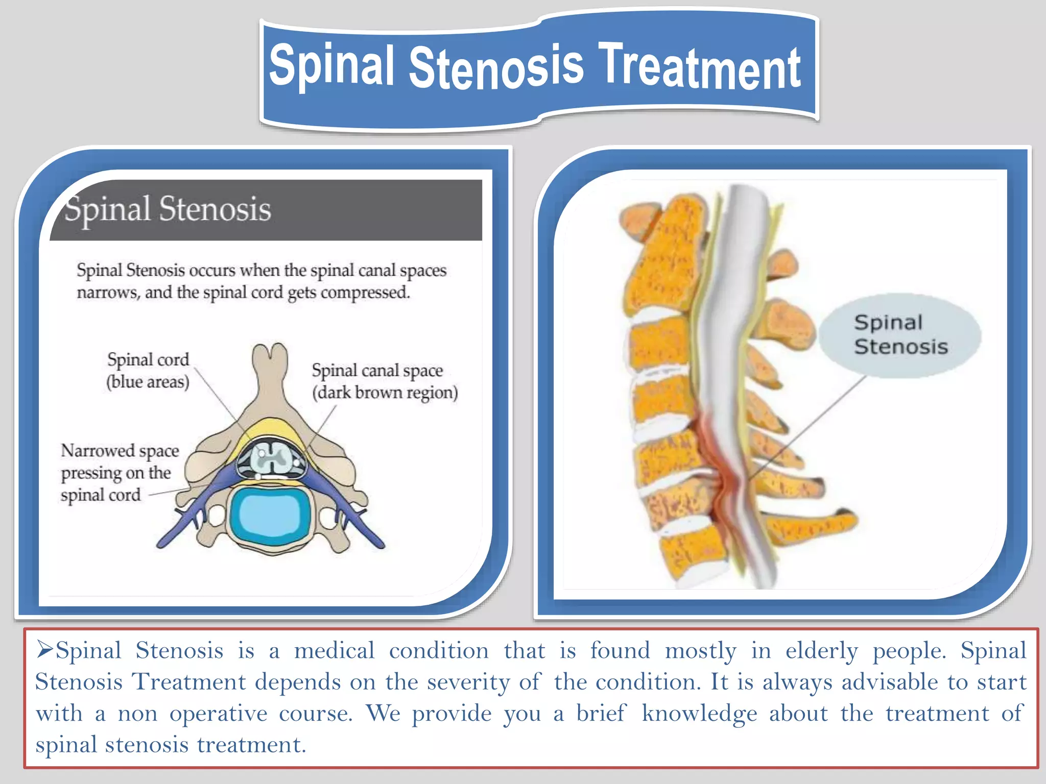 Spinal Stenosis is a medical condition that is found mostly in elderly people. Spinal
Stenosis Treatment depends on the severity of the condition. It is always advisable to start
with a non operative course. We provide you a brief knowledge about the treatment of
spinal stenosis treatment.