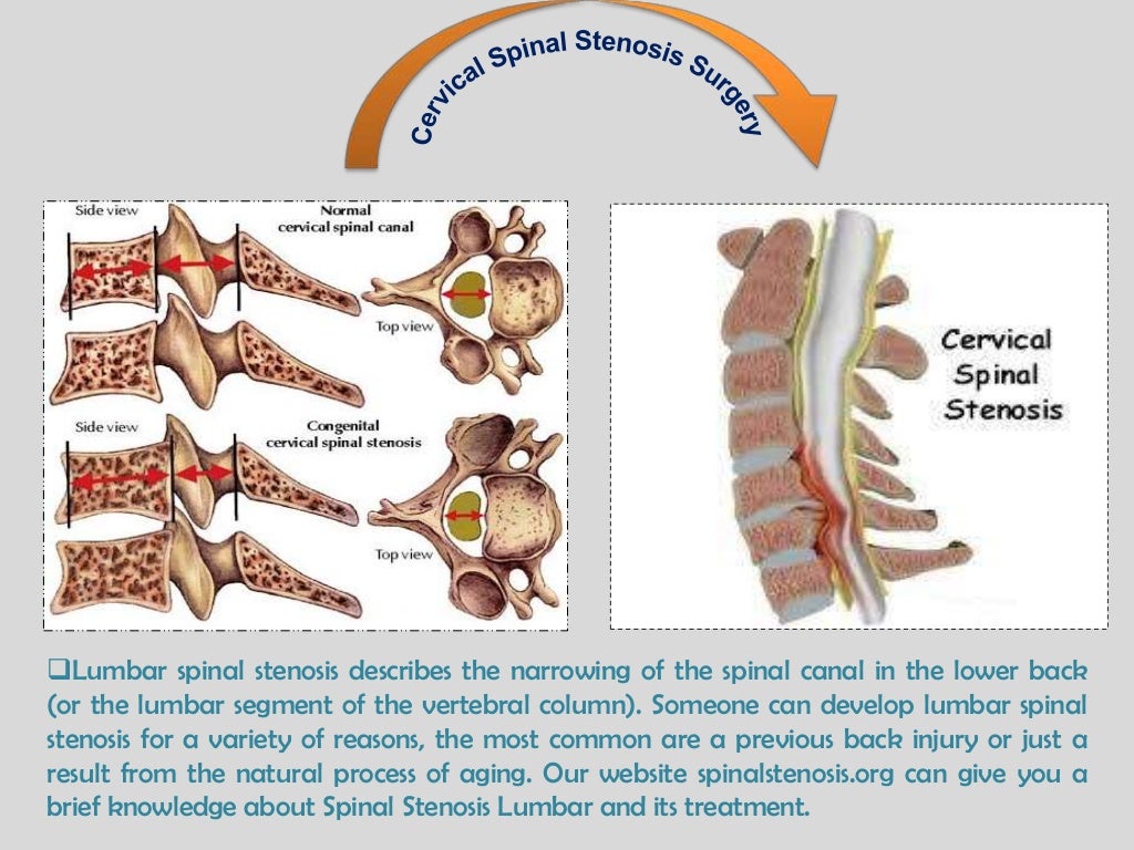Cervical spinal stenosis surgery