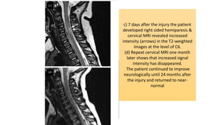 c) 7 days after the injury the patient
developed right sided hemiparesis &
cervical MRI revealed increased
intensity (arrows) in the T2-weighted
images at the level of C6.
(d) Repeat cervical MRI one month
later shows that increased signal
intensity has disappeared.
The patient continued to improve
neurologically until 24 months after
the injury and returned to near-
normal
 