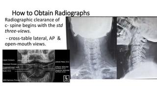 How to Obtain Radiographs
Radiographic clearance of
c- spine begins with the std
three-views.
- cross-table lateral, AP &
open-mouth views.
 