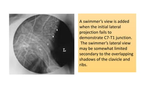 A swimmer’s view is added
when the initial lateral
projection fails to
demonstrate C7-T1 junction.
The swimmer’s lateral view
may be somewhat limited
secondary to the overlapping
shadows of the clavicle and
ribs.
 