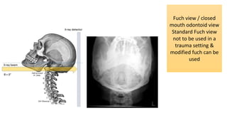 Fuch view / closed
mouth odontoid view
Standard Fuch view
not to be used in a
trauma setting &
modified fuch can be
used
 
